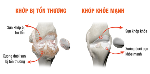 Sống tự chủ hơn nhờ chăm sóc xương khớp đúng cách - Ảnh 2. Sống tự chủ hơn nhờ chăm sóc xương khớp đúng cách - Ảnh 2.
