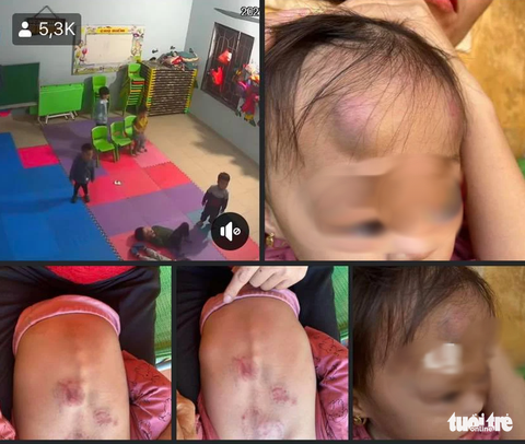 Đình chỉ cơ sở mầm non sau vụ bé 22 tháng tuổi bị bạn đánh bầm tím người - Ảnh 2. Đình chỉ cơ sở mầm non sau vụ bé 22 tháng tuổi bị bạn đánh bầm tím người - Ảnh 2.