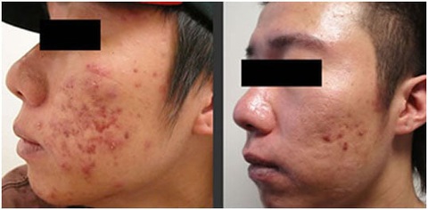 Nghiên cứu sử dụng hoạt chất trong điều trị mụn trứng cá - Ảnh 1. Nghiên cứu sử dụng hoạt chất trong điều trị mụn trứng cá - Ảnh 1.