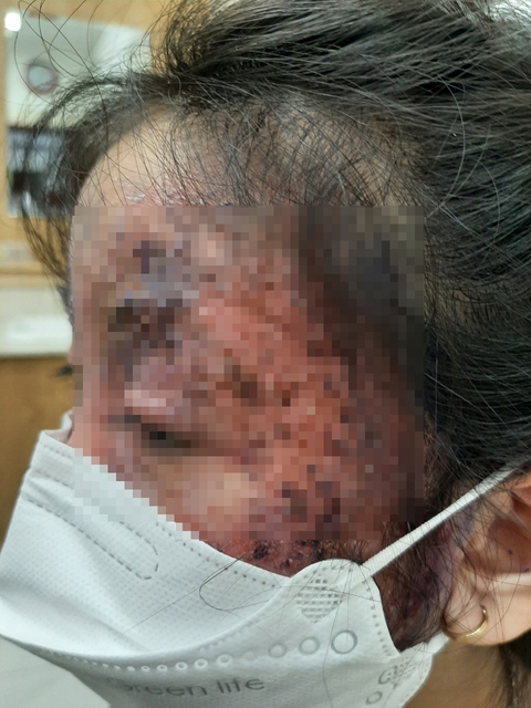 Bé gái tổn thương nửa mặt do trị nấm sai cách - Ảnh 1. Bé gái tổn thương nửa mặt do trị nấm sai cách - Ảnh 1.