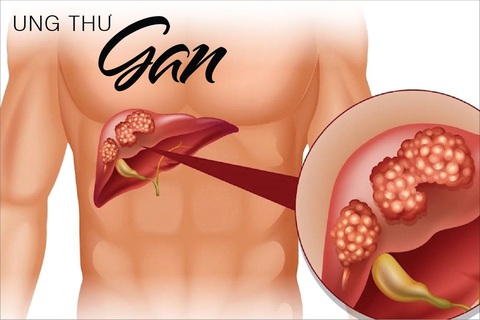 Fucoidan mang đến hi vọng cho người ung thư gan - Ảnh 1. Fucoidan mang đến hi vọng cho người ung thư gan - Ảnh 1.