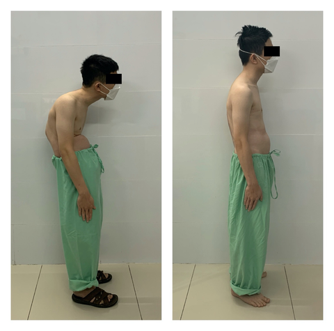 Phẫu thuật nắn cột sống cho nam thanh niên bị còng không thể nhìn thẳng - Ảnh 1. Phẫu thuật nắn cột sống cho nam thanh niên bị còng không thể nhìn thẳng - Ảnh 1.