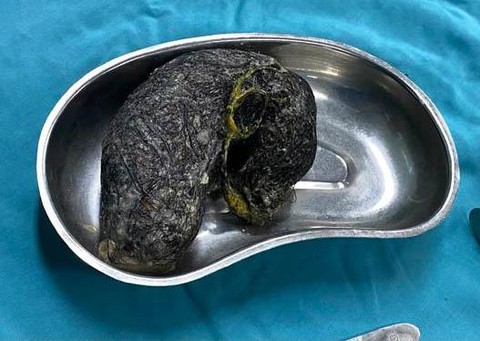 Hơn nửa ký tóc trong bụng bé 7 tuổi thích ăn tóc - Ảnh 1. Hơn nửa ký tóc trong bụng bé 7 tuổi thích ăn tóc - Ảnh 1.