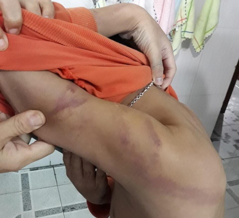 Xử phạt 1,5 triệu đồng người cha đánh con chằng chịt vết bầm tím - Ảnh 1. Xử phạt 1,5 triệu đồng người cha đánh con chằng chịt vết bầm tím - Ảnh 1.