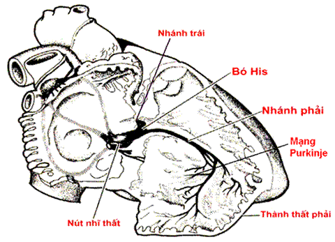 Tin vui cho người suy tim: Ca đầu tiên thực hiện thành công kỹ thuật tạo nhịp tim từ bó his trái - Ảnh 2. Tin vui cho người suy tim: Ca đầu tiên thực hiện thành công kỹ thuật tạo nhịp tim từ bó his trái - Ảnh 2.