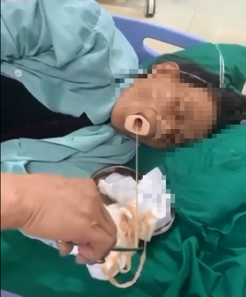Gắp sán dây dài 6m trong dạ dày người phụ nữ hay ăn đồ tái, sống - Ảnh 1. Gắp sán dây dài 6m trong dạ dày người phụ nữ hay ăn đồ tái, sống - Ảnh 1.