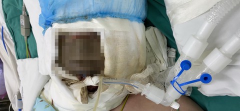 Ngã úp mặt vào nồi nước xông phòng COVID-19, bé gái 14 tuổi nguy kịch - Ảnh 1. Ngã úp mặt vào nồi nước xông phòng COVID-19, bé gái 14 tuổi nguy kịch - Ảnh 1.