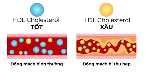 Nguy cơ đột quỵ mùa lạnh đối với người mỡ máu cao sau tuổi 50 - Ảnh 1. Nguy cơ đột quỵ mùa lạnh đối với người mỡ máu cao sau tuổi 50 - Ảnh 1.