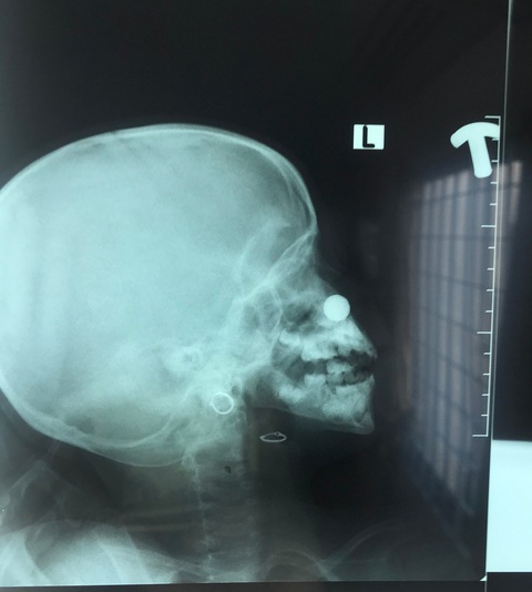 Nhét pin vào mũi, bé gái 4 tuổi bị axit phá hủy niêm mạc - Ảnh 1. Nhét pin vào mũi, bé gái 4 tuổi bị axit phá hủy niêm mạc - Ảnh 1.