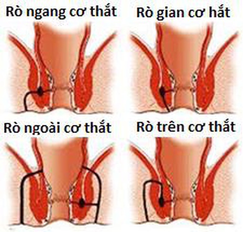 Điều trị rò hậu môn (mạch lươn) bằng phương pháp phẫu thuật - Ảnh 2. Điều trị rò hậu môn (mạch lươn) bằng phương pháp phẫu thuật - Ảnh 2.