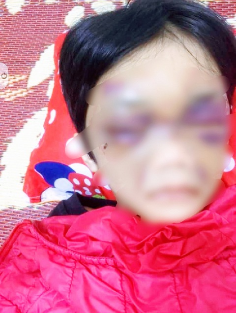 Bé gái 6 tuổi bị mẹ ruột đánh thâm tím mặt, tinh thần hoảng loạn - Ảnh 1. Bé gái 6 tuổi bị mẹ ruột đánh thâm tím mặt, tinh thần hoảng loạn - Ảnh 1.