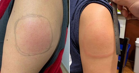 Hiện tượng tay sưng đỏ sau khi tiêm vaccine COVID-19 của Moderna - Ảnh 1. Hiện tượng tay sưng đỏ sau khi tiêm vaccine COVID-19 của Moderna - Ảnh 1.