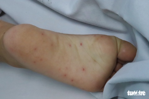Vì sao TP.HCM tăng số ca bệnh tay chân miệng độ nặng? - Ảnh 2. Vì sao TP.HCM tăng số ca bệnh tay chân miệng độ nặng? - Ảnh 2.