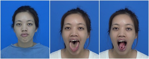 Cô gái 21 năm sống với chiếc lưỡi khổng lồ: Ca cực hiếm, thách thức cả êkip chuyên gia - Ảnh 1. Cô gái 21 năm sống với chiếc lưỡi khổng lồ: Ca cực hiếm, thách thức cả êkip chuyên gia - Ảnh 1.
