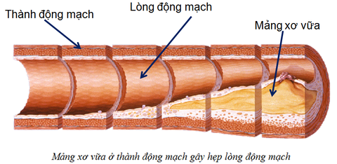 Chương trình tư vấn: Những điều cần biết về bệnh động mạch vành - Ảnh 4. Chương trình tư vấn: Những điều cần biết về bệnh động mạch vành - Ảnh 4.