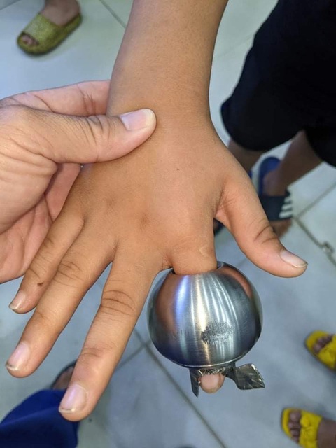 Bác sĩ phải dùng cưa điện thay dao mổ cứu ngón tay của bé trai - Ảnh 1. Bác sĩ phải dùng cưa điện thay dao mổ cứu ngón tay của bé trai - Ảnh 1.