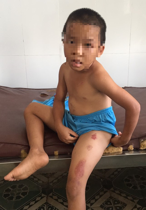 Bé trai 6 tuổi bị cha dượng bạo hành dã man - Ảnh 1. Bé trai 6 tuổi bị cha dượng bạo hành dã man - Ảnh 1.