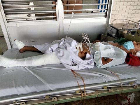 Đuổi bắt cướp, một công an xã bị cướp ép xe ngã trọng thương - Ảnh 2. Đuổi bắt cướp, một công an xã bị cướp ép xe ngã trọng thương - Ảnh 2.