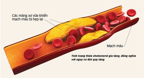 Kiểm soát thừa cholesterol: giảm 27% nguy cơ đột quỵ - Ảnh 1. Kiểm soát thừa cholesterol: giảm 27% nguy cơ đột quỵ - Ảnh 1.