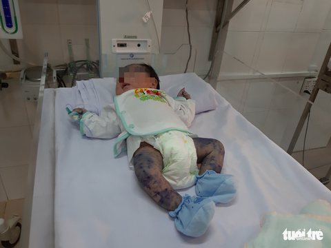 Cứu sống bé trai bị thủy đậu hiếm gặp khi mới chào đời - Ảnh 1. Cứu sống bé trai bị thủy đậu hiếm gặp khi mới chào đời - Ảnh 1.