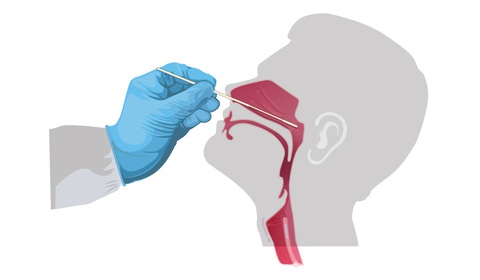 Nhiễm COVID-19, sao có người bị nặng, người nhẹ? - Ảnh 2. Nhiễm COVID-19, sao có người bị nặng, người nhẹ? - Ảnh 2.