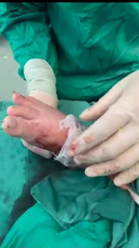 Phẫu thuật 5 lần để cứu bàn chân bị đứt lìa của bé trai 5 tuổi - Ảnh 1. Phẫu thuật 5 lần để cứu bàn chân bị đứt lìa của bé trai 5 tuổi - Ảnh 1.