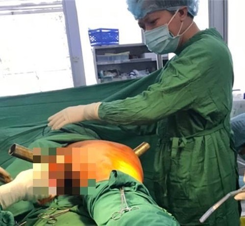 Cấp cứu thành công nam thanh niên bị ống sắt dài 50cm đâm xuyên vùng bẹn - Ảnh 1. Cấp cứu thành công nam thanh niên bị ống sắt dài 50cm đâm xuyên vùng bẹn - Ảnh 1.