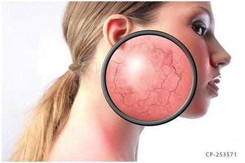 Sử dụng thuốc ngoài da chứa Corticoid liệu có ‘thần thánh’ như bạn nghĩ? - Ảnh 3. Sử dụng thuốc ngoài da chứa Corticoid liệu có ‘thần thánh’ như bạn nghĩ? - Ảnh 3.