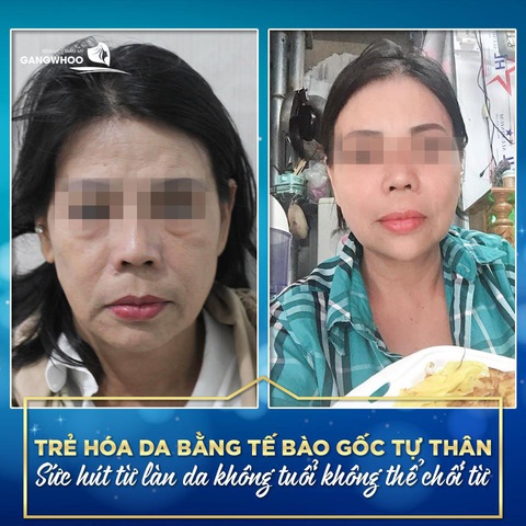 Trẻ hóa da mặt đón xuân sang tại Bệnh viện thẩm mỹ Gangwhoo - Ảnh 1. Trẻ hóa da mặt đón xuân sang tại Bệnh viện thẩm mỹ Gangwhoo - Ảnh 1.