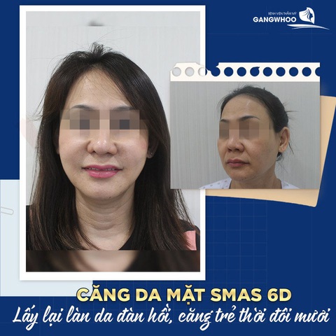 Trẻ hóa da mặt đón xuân sang tại Bệnh viện thẩm mỹ Gangwhoo - Ảnh 3. Trẻ hóa da mặt đón xuân sang tại Bệnh viện thẩm mỹ Gangwhoo - Ảnh 3.
