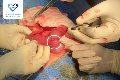 Bé gái 7 tuổi nhập viện cấp cứu do lồng ruột bởi polyp hồi tràng - Ảnh 1. Bé gái 7 tuổi nhập viện cấp cứu do lồng ruột bởi polyp hồi tràng - Ảnh 1.