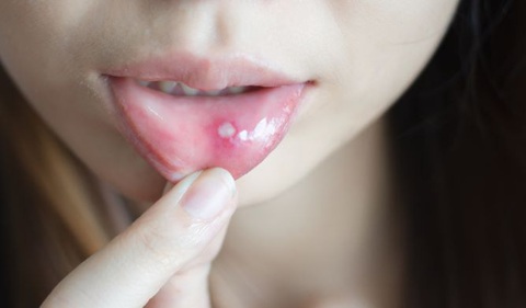 Sủi thanh nhiệt từ thảo dược Việt - Chẳng còn nỗi lo nhiệt miệng - Ảnh 1. Sủi thanh nhiệt từ thảo dược Việt - Chẳng còn nỗi lo nhiệt miệng - Ảnh 1.