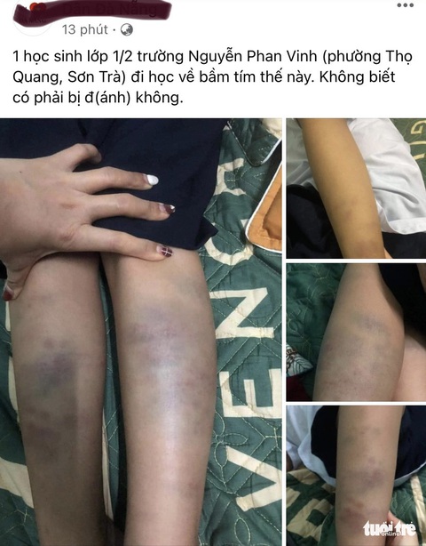 Xác minh vụ học sinh lớp 1 ở Đà Nẵng bị bầm tím chân tay khi đi học về - Ảnh 1. Xác minh vụ học sinh lớp 1 ở Đà Nẵng bị bầm tím chân tay khi đi học về - Ảnh 1.