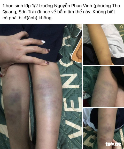 Học sinh lớp 1 bị bầm tím tay chân do bạn dùng thước đánh khi kèm học - Ảnh 1. Học sinh lớp 1 bị bầm tím tay chân do bạn dùng thước đánh khi kèm học - Ảnh 1.