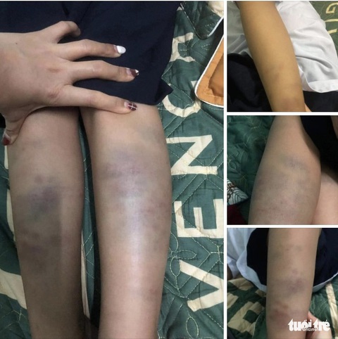 Vụ học sinh lớp 1 bị đánh bầm tím: Cô hay bạn đánh cũng là trách nhiệm của cô giáo - Ảnh 1. Vụ học sinh lớp 1 bị đánh bầm tím: Cô hay bạn đánh cũng là trách nhiệm của cô giáo - Ảnh 1.