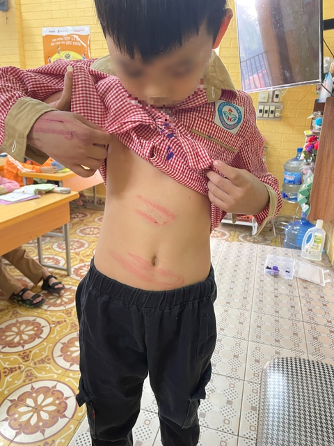 Nghi vấn bé trai 8 tuổi bị bạn trai của mẹ bạo hành tím bầm khắp người - Ảnh 1. Nghi vấn bé trai 8 tuổi bị bạn trai của mẹ bạo hành tím bầm khắp người - Ảnh 1.