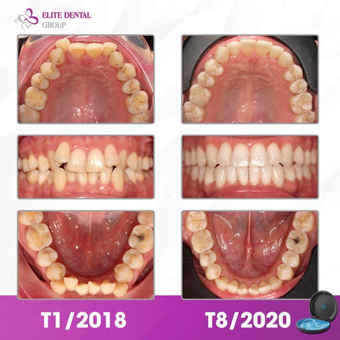 Nắm vững các lưu ý khi niềng răng để đạt hiệu quả cao - Ảnh 2. Nắm vững các lưu ý khi niềng răng để đạt hiệu quả cao - Ảnh 2.