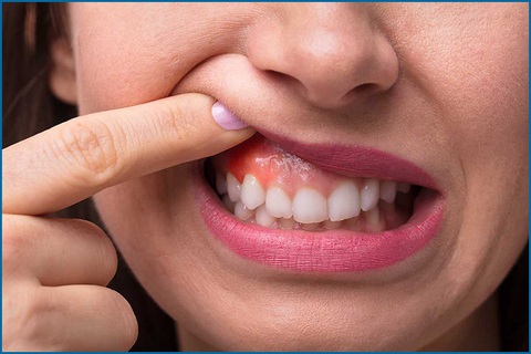 6 triệu chứng ung thư miệng dễ bị bỏ qua - Ảnh 1. 6 triệu chứng ung thư miệng dễ bị bỏ qua - Ảnh 1.