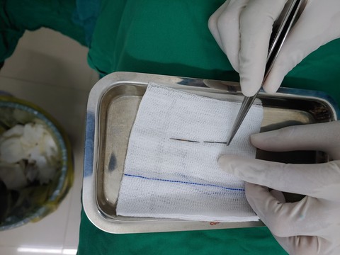 Bất ngờ phát hiện chiếc kim may dài 4-5cm trong phổi bé trai 4 tuổi - Ảnh 1. Bất ngờ phát hiện chiếc kim may dài 4-5cm trong phổi bé trai 4 tuổi - Ảnh 1.