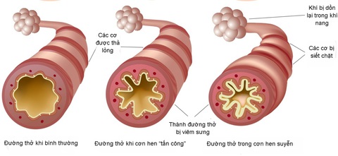 Giải pháp hỗ trợ cải thiện ho, khò khè, khó thở - Ảnh 1. Giải pháp hỗ trợ cải thiện ho, khò khè, khó thở - Ảnh 1.