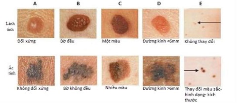 Khi nào nốt ruồi cảnh báo bạn mắc ung thư? - Ảnh 1. Khi nào nốt ruồi cảnh báo bạn mắc ung thư? - Ảnh 1.
