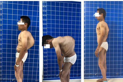 Cắt xương sườn, ‘tái sinh’ cột sống cho bệnh nhân gù lưng hơn 100 độ - Ảnh 1. Cắt xương sườn, ‘tái sinh’ cột sống cho bệnh nhân gù lưng hơn 100 độ - Ảnh 1.