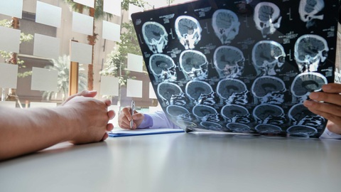 AI giúp chẩn đoán sớm và tìm ra phương pháp điều trị cho người đột quỵ - Ảnh 1. AI giúp chẩn đoán sớm và tìm ra phương pháp điều trị cho người đột quỵ - Ảnh 1.