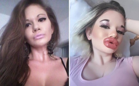 Cô Emi tiêm filler môi cho đã rồi đem đấu giá nụ hôn! - Ảnh 1. Cô Emi tiêm filler môi cho đã rồi đem đấu giá nụ hôn! - Ảnh 1.