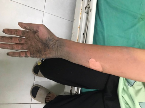 Điện thoại phát nổ lúc thiếu niên vừa dùng nghe vừa sạc pin - Ảnh 1. Điện thoại phát nổ lúc thiếu niên vừa dùng nghe vừa sạc pin - Ảnh 1.