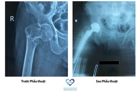 Bệnh Viện Tâm Trí Đồng Tháp thay khớp háng cho bệnh nhân có bệnh nền phức tạp - Ảnh 1. Bệnh Viện Tâm Trí Đồng Tháp thay khớp háng cho bệnh nhân có bệnh nền phức tạp - Ảnh 1.