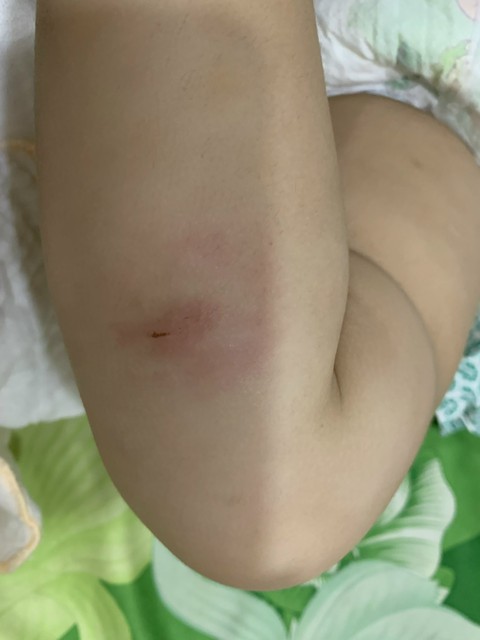 Trẻ mẫu giáo bị bạn cắn nhiều lần, trường cho nghỉ học vì quá áp lực - Ảnh 4. Trẻ mẫu giáo bị bạn cắn nhiều lần, trường cho nghỉ học vì quá áp lực - Ảnh 4.
