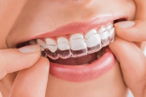 Phương pháp niềng răng trong suốt thu hút giới trẻ - Ảnh 1. Phương pháp niềng răng trong suốt thu hút giới trẻ - Ảnh 1.