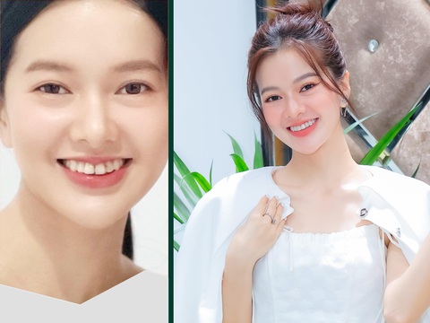 Phương pháp niềng răng trong suốt thu hút giới trẻ - Ảnh 3. Phương pháp niềng răng trong suốt thu hút giới trẻ - Ảnh 3.