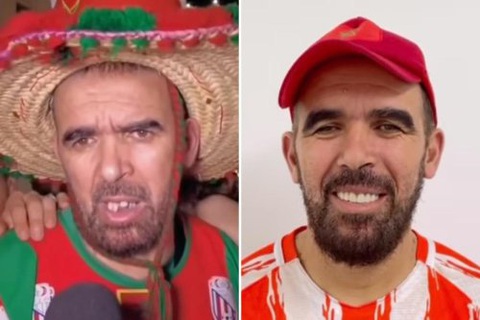 Người hâm mộ World Cup bị bắt nạt vì răng xấu được nha sĩ chữa miễn phí - Ảnh 1. Người hâm mộ World Cup bị bắt nạt vì răng xấu được nha sĩ chữa miễn phí - Ảnh 1.